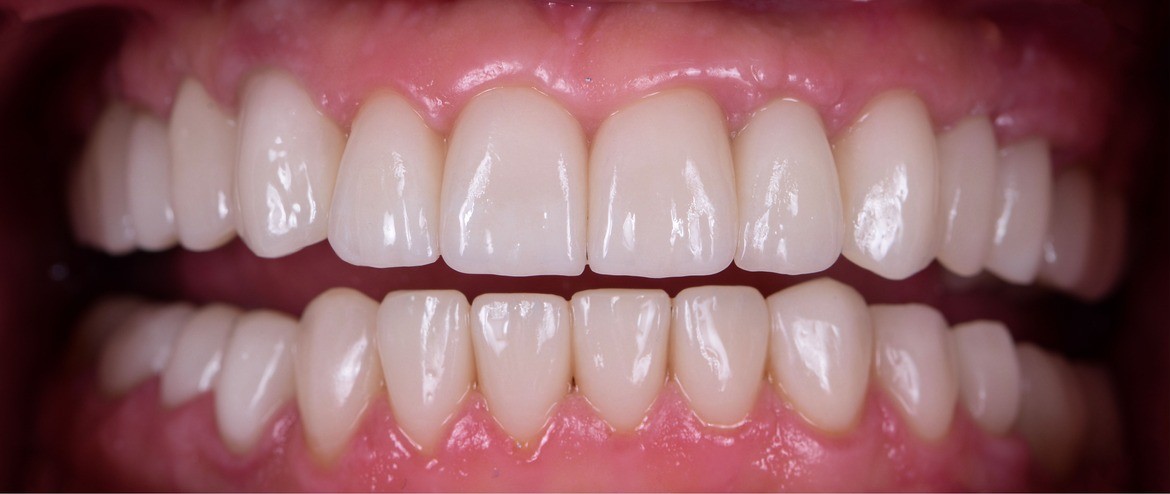Teeth after crowns