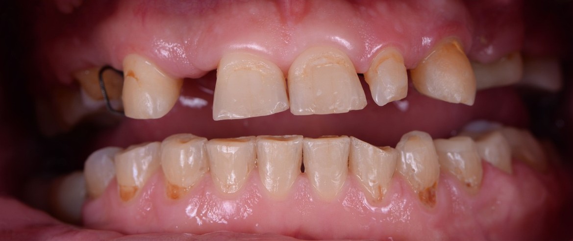 Teeth before crowns