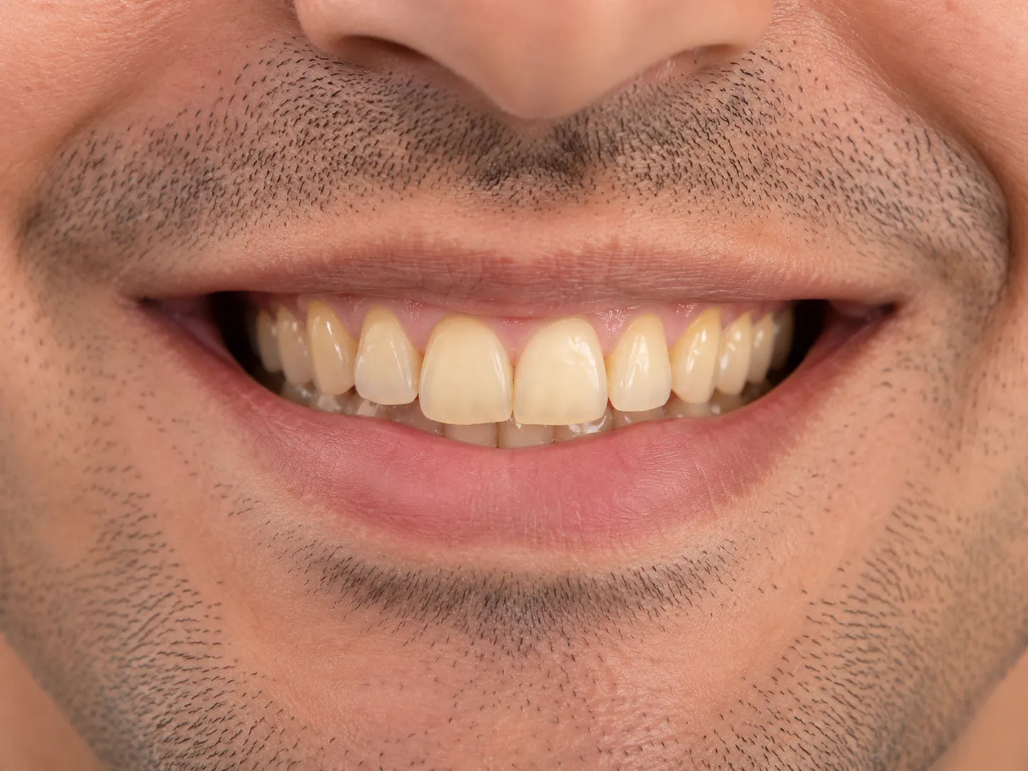 Teeth before whitening