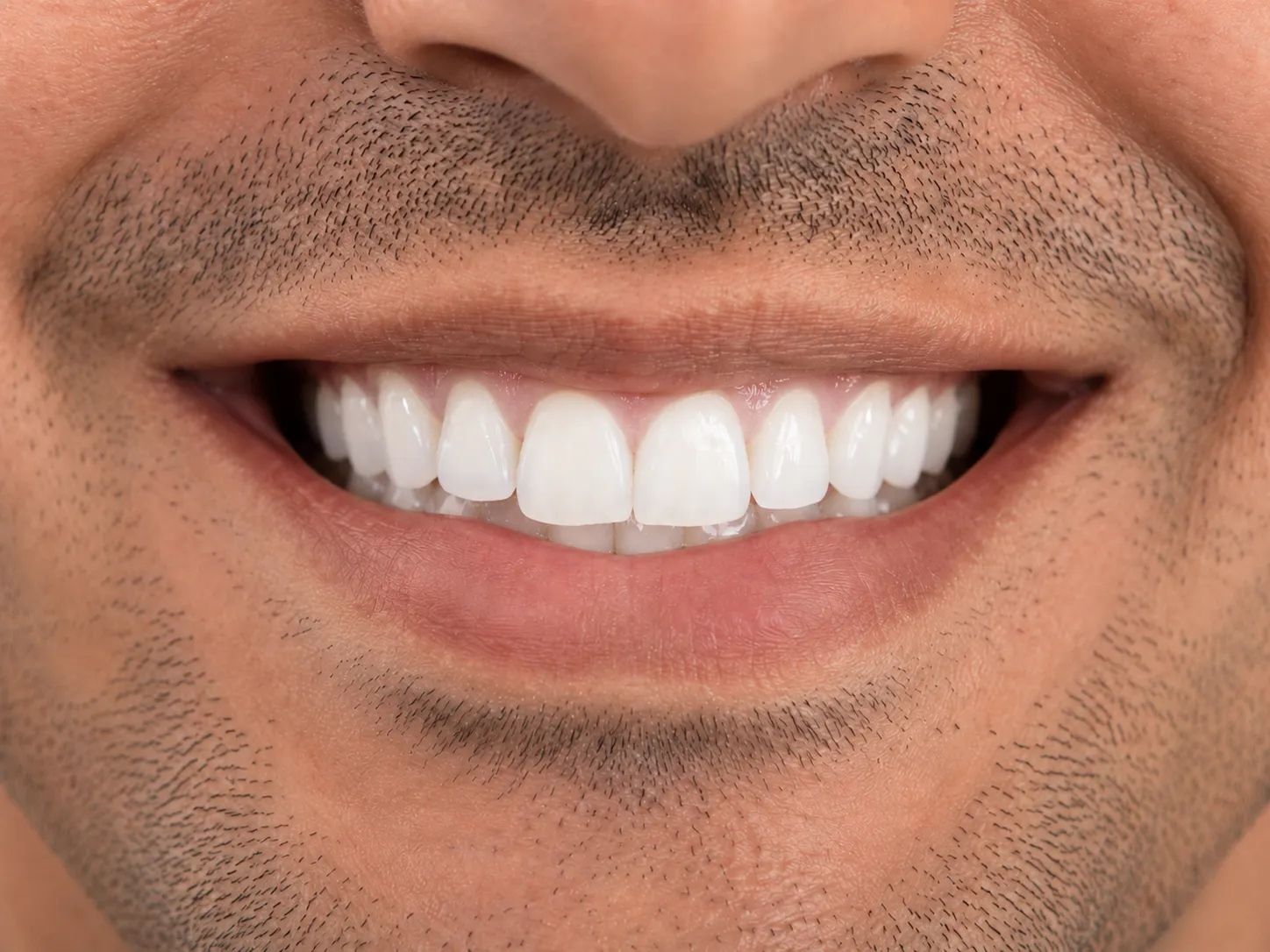 Teeth after whitening