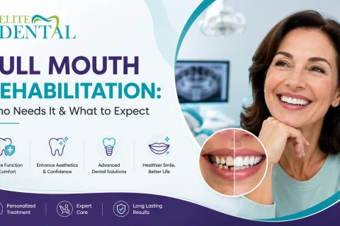 Full mouth dental implants