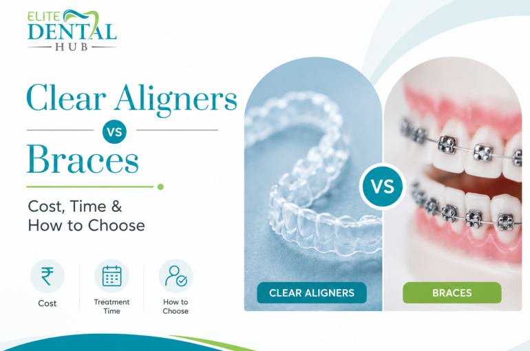 Clear Aligners VS Braces Chandigarh
