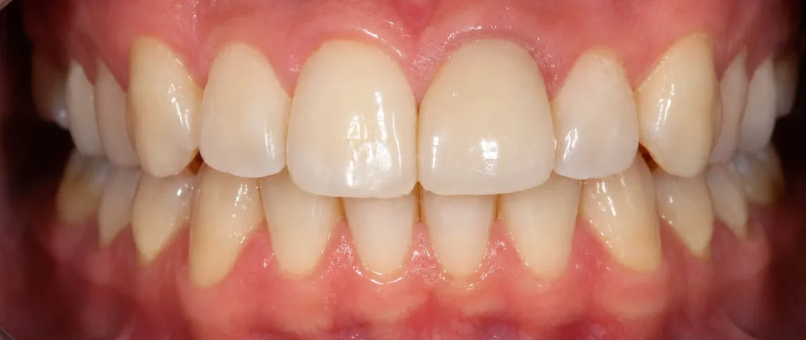 root canal treatment Chandigarh