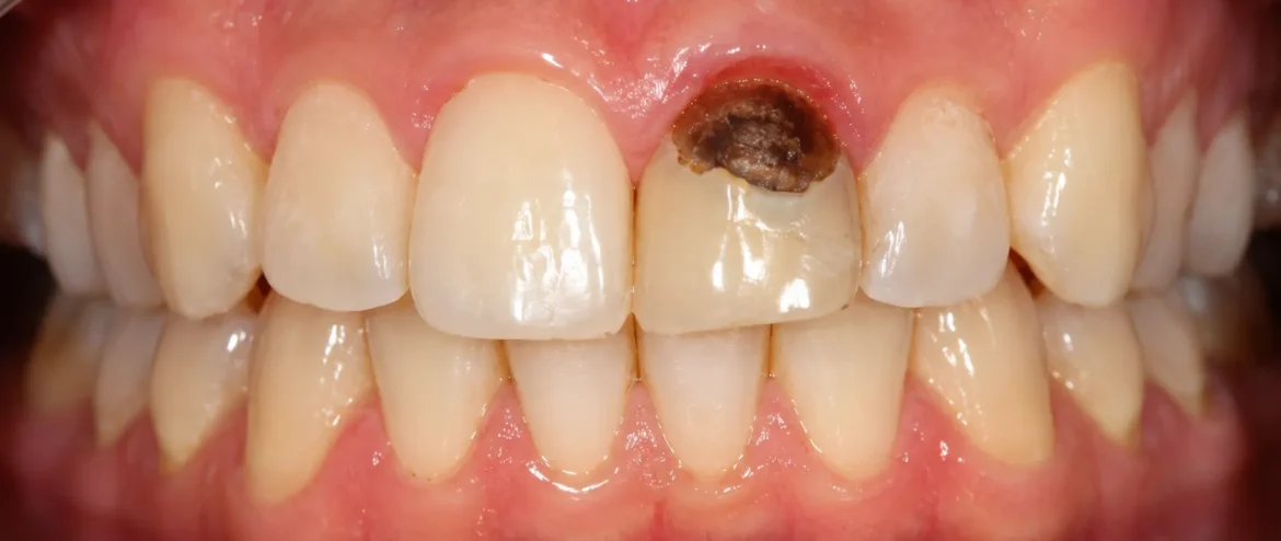 root canal treatment Chandigarh