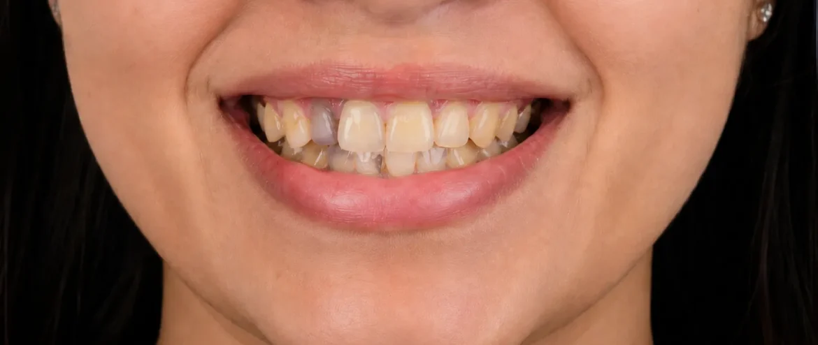 broken tooth repair Chandigarh