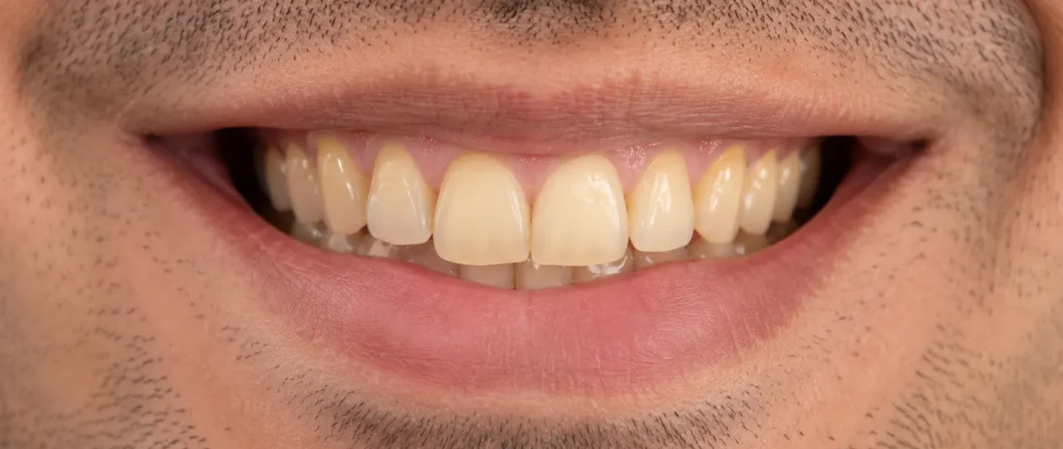Teeth Whitening in Chandigarh